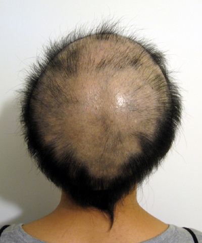 汎発型円形脱毛症
