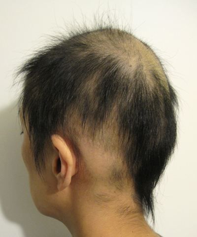 汎発型円形脱毛症