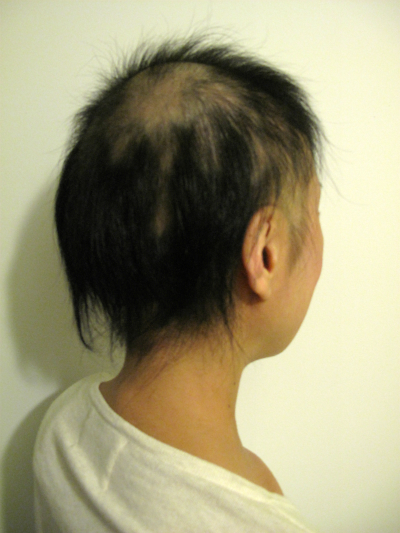 悪性円形脱毛症 1年1ヶ月経過 写真
