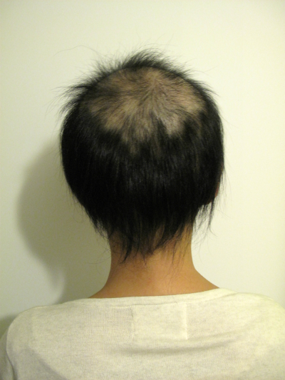 悪性円形脱毛症 1年1ヶ月経過 写真
