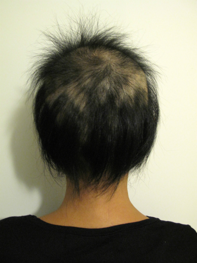 全頭型円形脱毛症 1年3ヶ月経過 写真