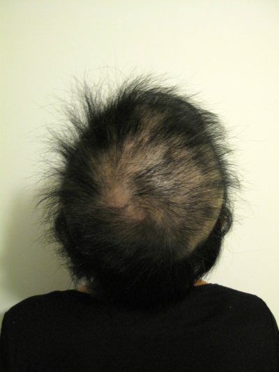 全頭型円形脱毛症 1年3ヶ月経過 写真