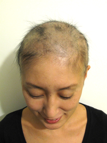 alopecia areata totalis