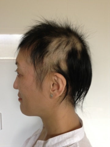 alopecia_areata2