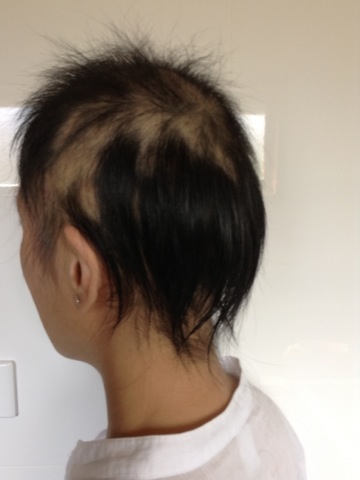 alopecia_areata3