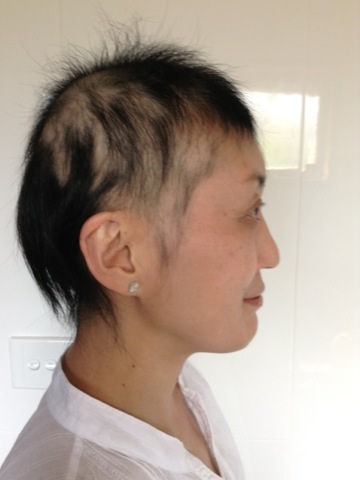 alopecia_areata7