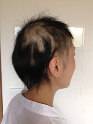 alopecia_areata8