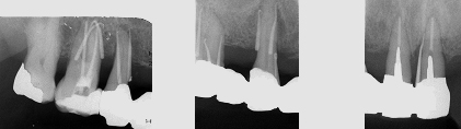 右上の歯周病の状態